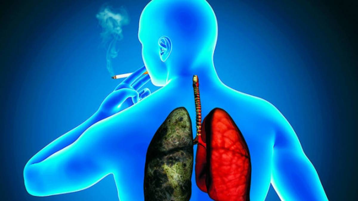cáncer de pulmon