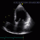 herzzentrum_brandenburg_Myokarditis_schlechte_LVEF2